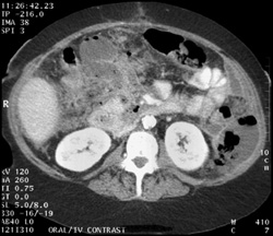 Pancreatic Abscess With Necrosis - CTisus CT Scan