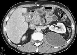 Pancreatitis With Fluid in Left Posterior Perarenal Space - CTisus CT Scan