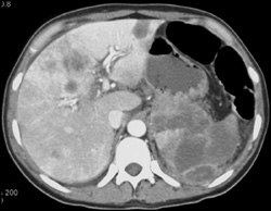 Islet Cell of Pancreas With Liver Metastases - CTisus CT Scan