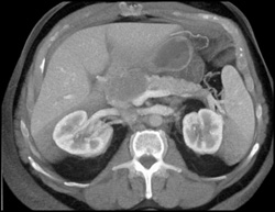 Pancreatic Cancer With Dilated Pancreatic Duct - CTisus CT Scan