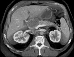 Pancreatic Cancer With Dilated Pancreatic Duct - CTisus CT Scan