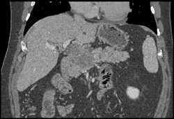 Pancreatic Cancer - CTisus CT Scan