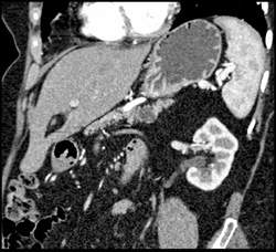 Intraductal Papillary Mucinous Neoplasm (IPMN) - CTisus CT Scan