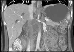 Pancreatic Cancer Invades the Renal Vein and IVC - CTisus CT Scan