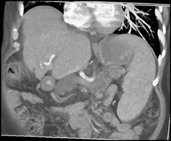 Diffuse Intraductal Papillary Mucinous Neoplasms (IPMNs) Involve the Pancreas - CTisus CT Scan