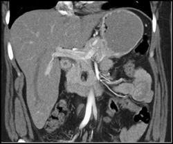 Pancreatic Lipoma - CTisus CT Scan