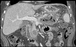 Pancreatic Abscess - CTisus CT Scan