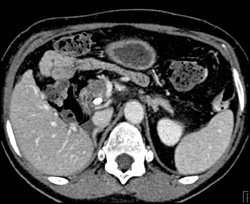 Pancreatic Cancer - CTisus CT Scan