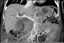 Pancreatic Cancer - CTisus CT Scan