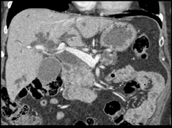 Pancreatic Cancer - CTisus CT Scan