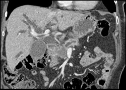 Pancreatic Cancer - CTisus CT Scan