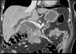 Pancreatic Cancer - CTisus CT Scan