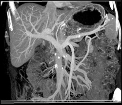 Pancreatic Cancer - CTisus CT Scan