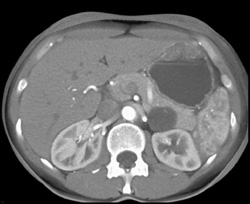 Cystadenoma - CTisus CT Scan