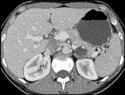 Cystadenoma - CTisus CT Scan