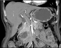 Intraductal Papillary Mucinous Neoplasm (IPMN) in Pancreatic Head - CTisus CT Scan