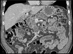 Intraductal Papillary Mucinous Neoplasm (IPMN) With Superimposed Cancer - CTisus CT Scan