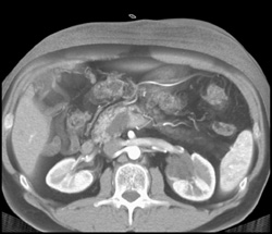 Intraductal Papillary Mucinous Neoplasm (IPMN) - CTisus CT Scan