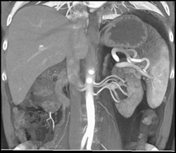 Intraductal Papillary Mucinous Neoplasm (IPMN) With Multiple Renal Arteries - CTisus CT Scan