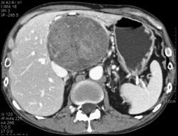 Giant Schwannoma - CTisus CT Scan