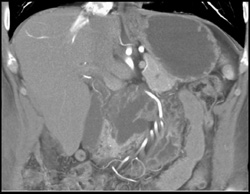 Intraductal Papillary Mucinous Neoplasm (IPMN) - CTisus CT Scan