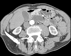 Intraductal Papillary Mucinous Neoplasm (IPMN) - CTisus CT Scan