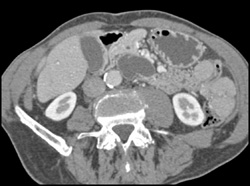 Intraductal Papillary Mucinous Neoplasm (IPMN) - CTisus CT Scan