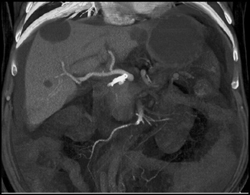 Pancreatic Cancer - CTisus CT Scan