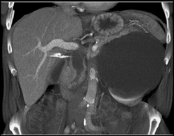 Tumor Encases the Distal Common Bile Duct - CTisus CT Scan