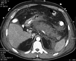 Acute Pancreatitis - CTisus CT Scan