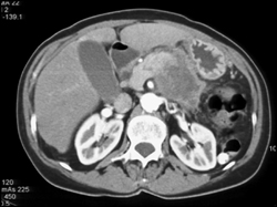 Implants in the Omentum From Pancreatic Adenocarcinoma - CTisus CT Scan