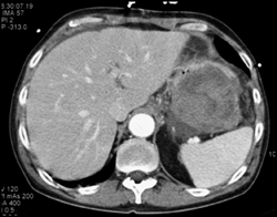 Hemorrhagic Pseudocyst - CTisus CT Scan