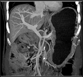 Encasement of PV/SMV Junction - CTisus CT Scan