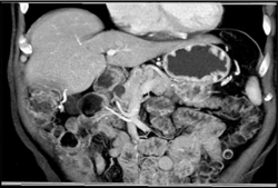 Intraductal Papillary Mucinous Neoplasm (IPMN) - CTisus CT Scan