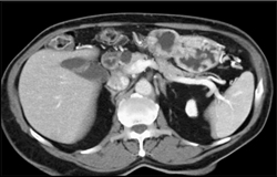 Intraductal Papillary Mucinous Neoplasm (IPMN) - CTisus CT Scan