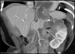 Hiatal Hernia and Cystadenocarcinoma - CTisus CT Scan