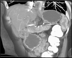 Pancreatic Adenocarcinoma - CTisus CT Scan