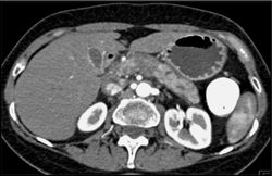 Pancreatic Adenocarcinoma - CTisus CT Scan