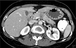 Pancreatic Adenocarcinoma - CTisus CT Scan