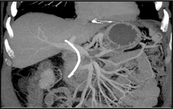 Pancreatic Cancer With PV/SMV Splenic Vein Encasement - CTisus CT Scan