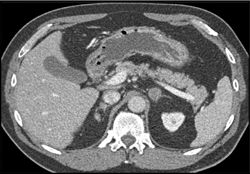 Focal Fat in the Pancreas - CTisus CT Scan