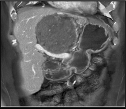 Schwannoma Simulates A Pancreatic Mass - CTisus CT Scan