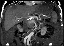 Post Embolization of A Gastroduodenal Artery (GDA) Aneurysm - CTisus CT Scan