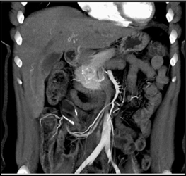 Islet Cell Tumor - CTisus CT Scan