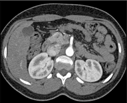 Islet Cell Tumor - CTisus CT Scan