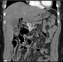 Islet Cell Tumor - CTisus CT Scan