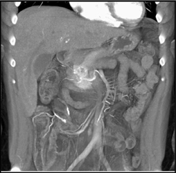 Islet Cell Tumor - CTisus CT Scan