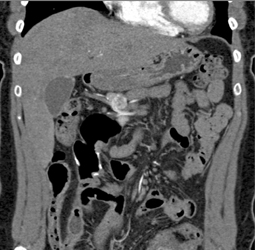 Islet Cell Tumor - CTisus CT Scan