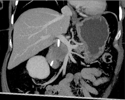 Pancreatic Cancer Compresses the Portal Vein - CTisus CT Scan