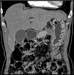 Pancreatic Cancer - CTisus CT Scan